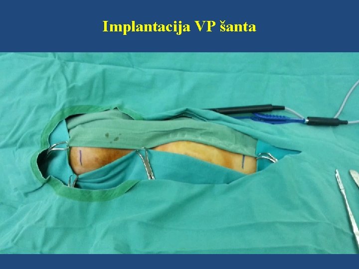 Implantacija VP šanta 