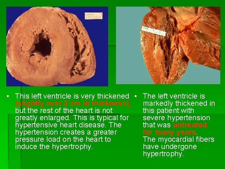  • This left ventricle is very thickened • The left ventricle is (slightly