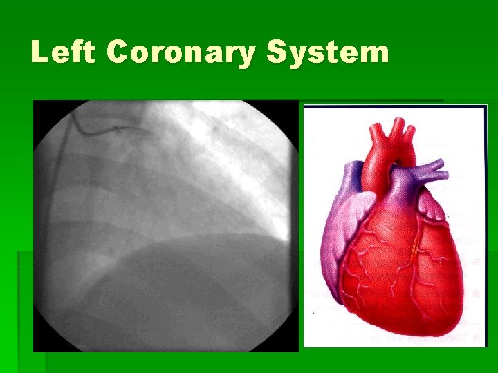 Left Coronary System 