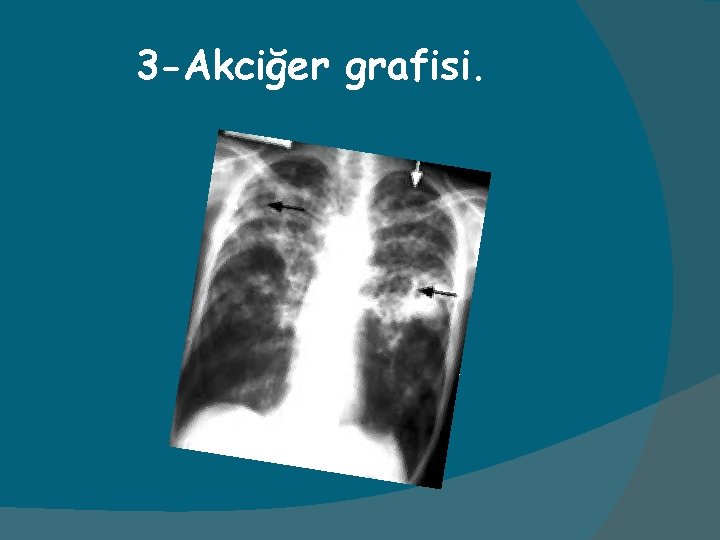 3 -Akciğer grafisi. 