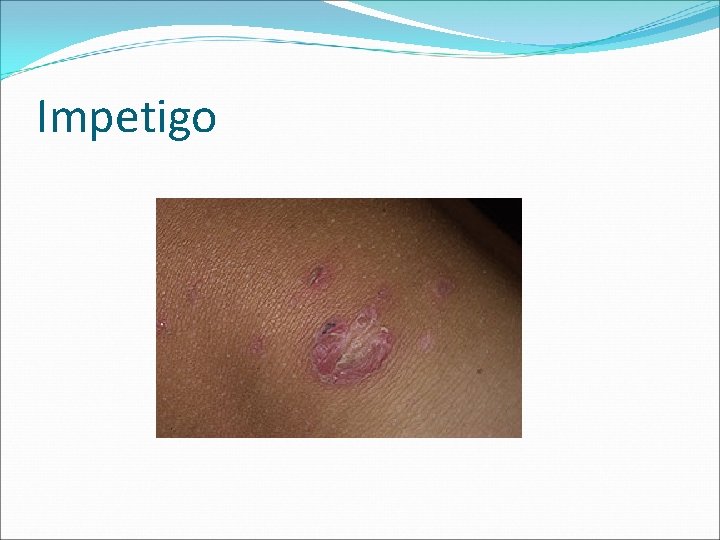 Impetigo 