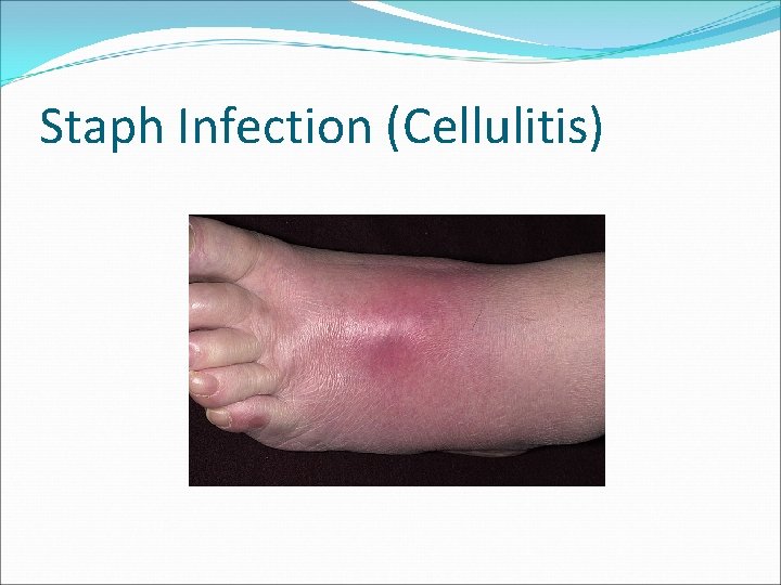 Staph Infection (Cellulitis) 