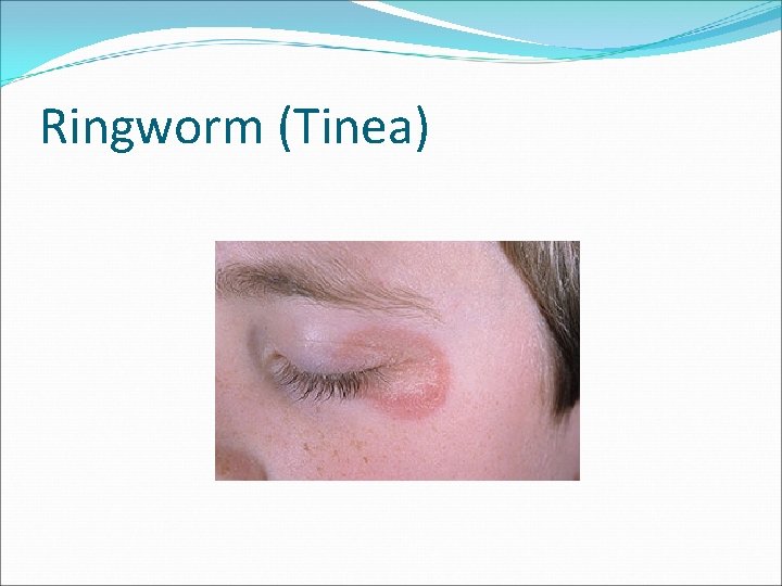Ringworm (Tinea) 