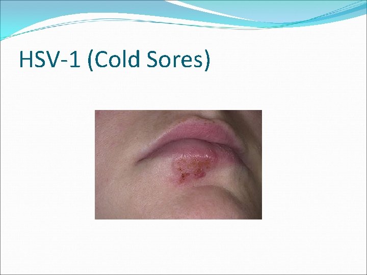 HSV-1 (Cold Sores) 