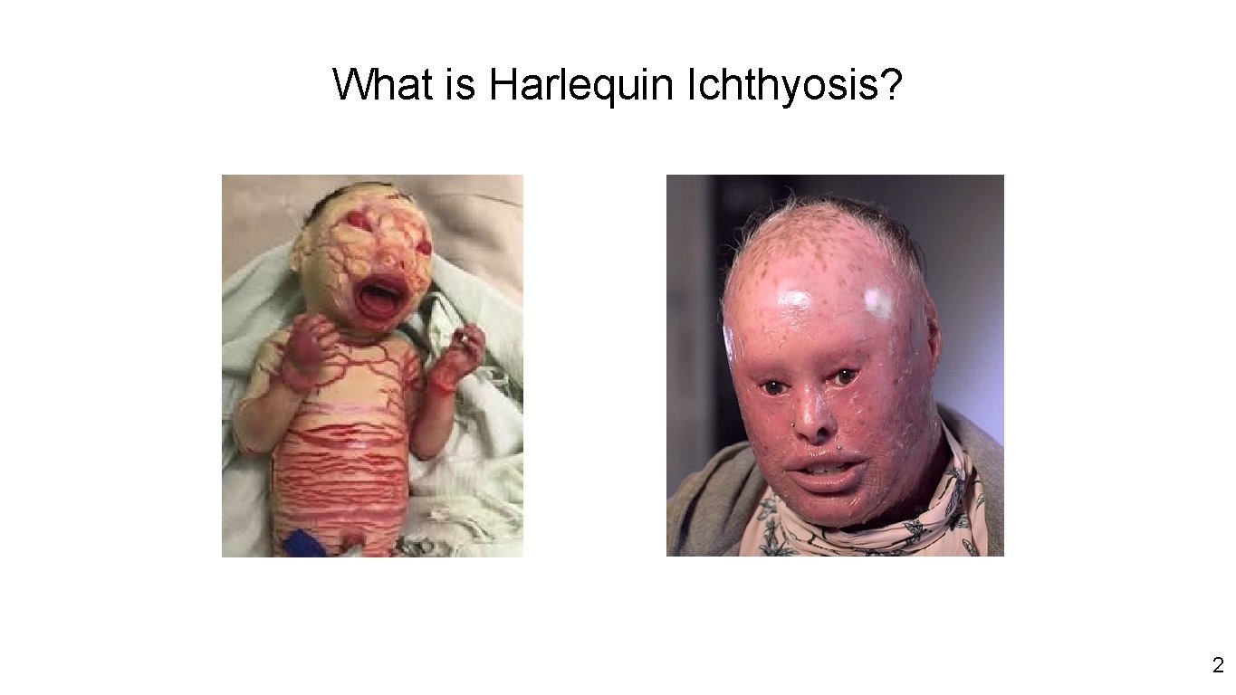 What is Harlequin Ichthyosis? 2 2 