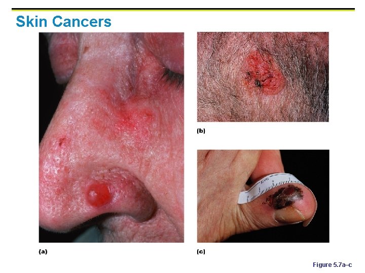 Skin Cancers Figure 5. 7 a–c 