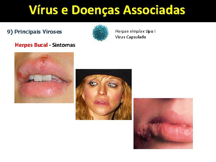 Vírus e Doenças Associadas 9) Principais Viroses Herpes Bucal - Sintomas Herpes simplex tipo