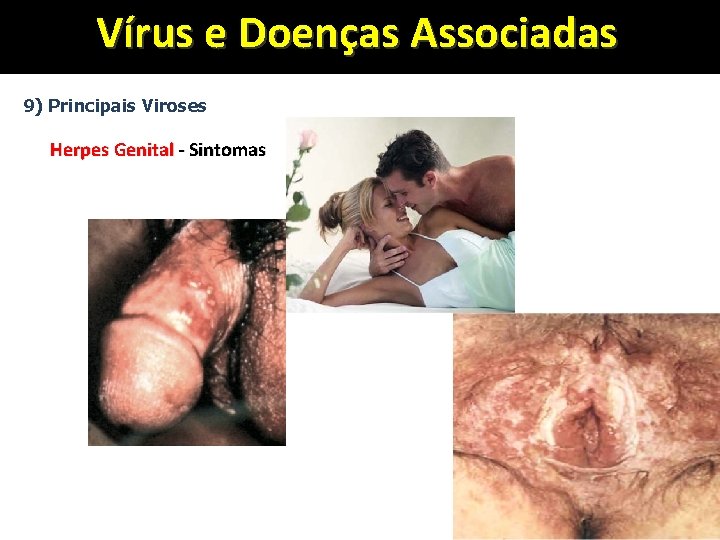 Vírus e Doenças Associadas 9) Principais Viroses Herpes Genital - Sintomas 