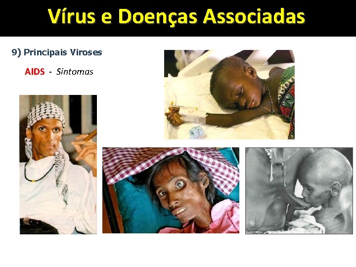Vírus e Doenças Associadas 9) Principais Viroses AIDS - Sintomas 