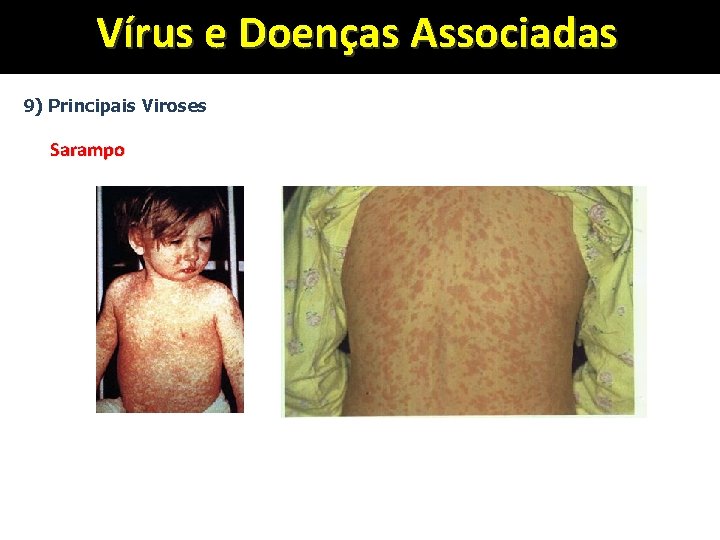 Vírus e Doenças Associadas 9) Principais Viroses Sarampo 