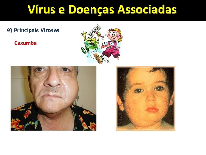 Vírus e Doenças Associadas 9) Principais Viroses Caxumba 