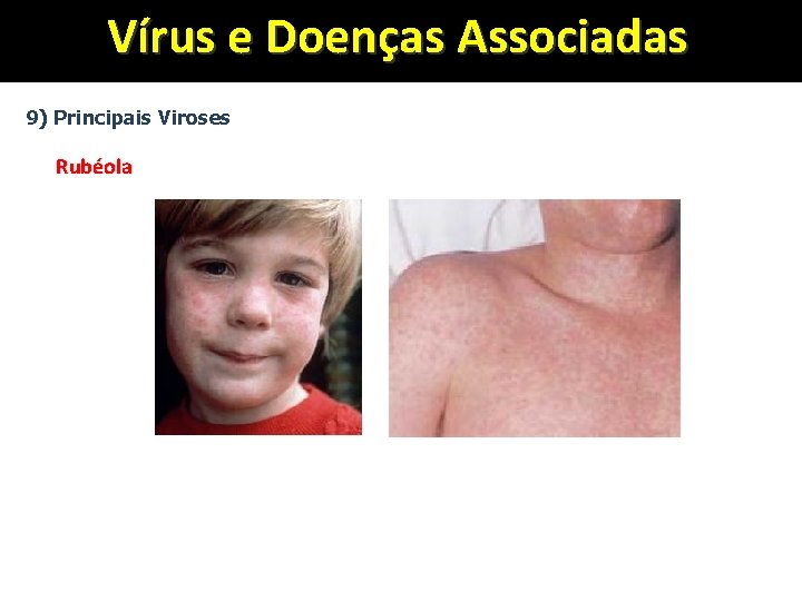 Vírus e Doenças Associadas 9) Principais Viroses Rubéola 