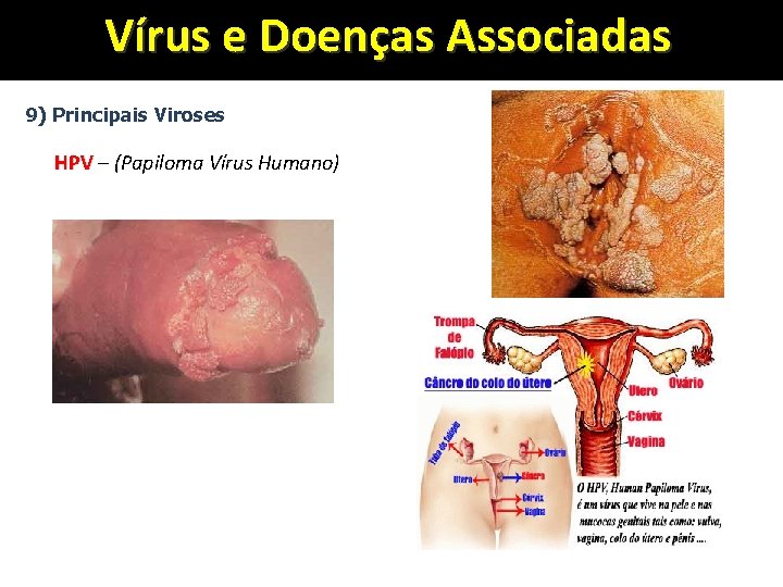Vírus e Doenças Associadas 9) Principais Viroses HPV – (Papiloma Vírus Humano) 