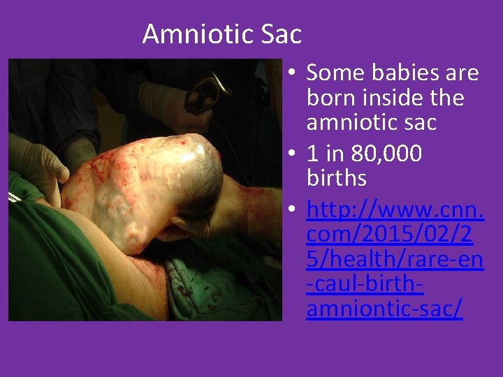 Amniotic Sac • Some babies are born inside the amniotic sac • 1 in