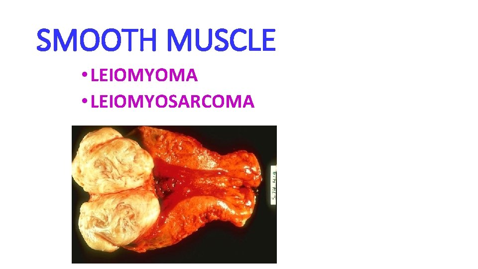 SMOOTH MUSCLE • LEIOMYOMA • LEIOMYOSARCOMA 