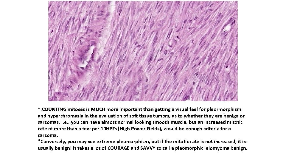 *. COUNTING mitoses is MUCH more important than getting a visual feel for pleormorphism