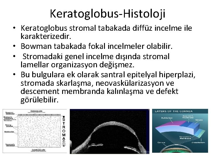 Keratoglobus-Histoloji • Keratoglobus stromal tabakada diffüz incelme ile karakterizedir. • Bowman tabakada fokal incelmeler