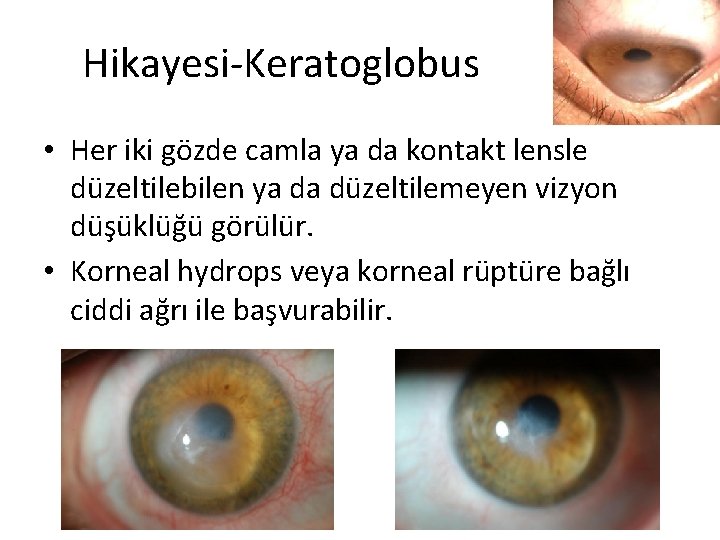 Hikayesi-Keratoglobus • Her iki gözde camla ya da kontakt lensle düzeltilebilen ya da düzeltilemeyen