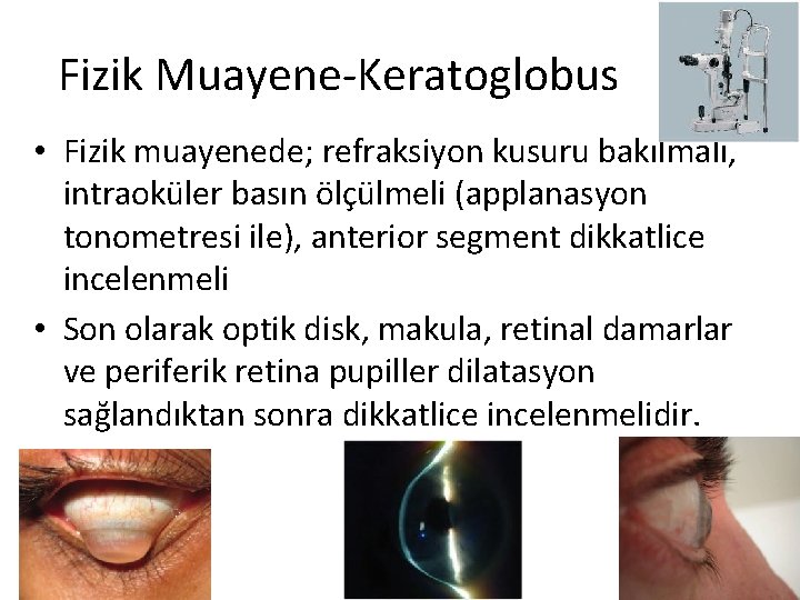 Fizik Muayene-Keratoglobus • Fizik muayenede; refraksiyon kusuru bakılmalı, intraoküler basın ölçülmeli (applanasyon tonometresi ile),