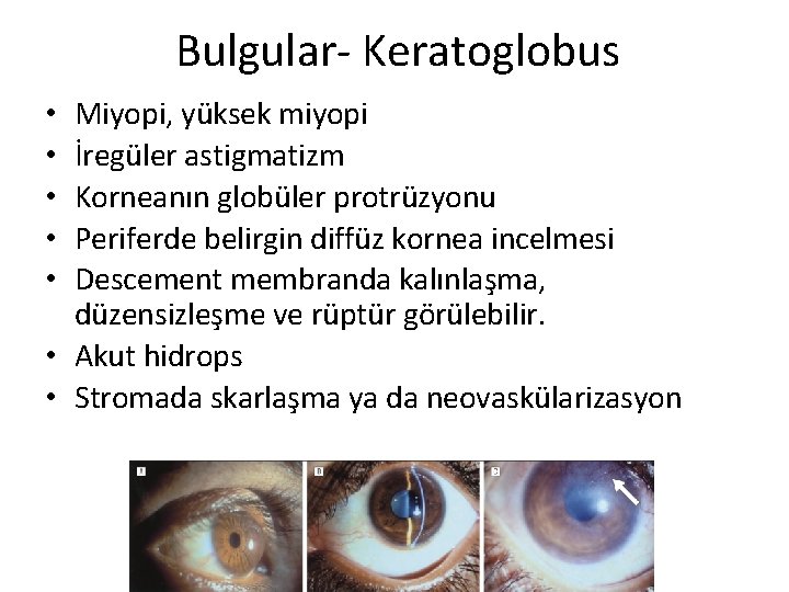 Bulgular- Keratoglobus Miyopi, yüksek miyopi İregüler astigmatizm Korneanın globüler protrüzyonu Periferde belirgin diffüz kornea