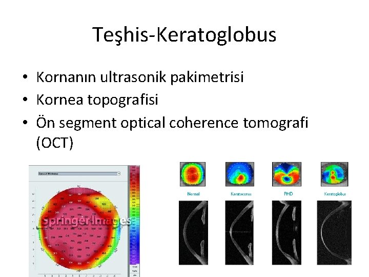 Teşhis-Keratoglobus • Kornanın ultrasonik pakimetrisi • Kornea topografisi • Ön segment optical coherence tomografi