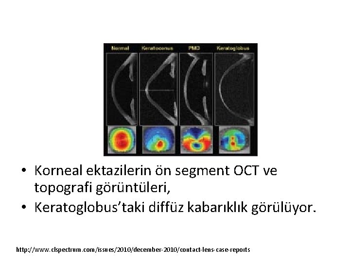  • Korneal ektazilerin ön segment OCT ve topografi görüntüleri, • Keratoglobus’taki diffüz kabarıklık