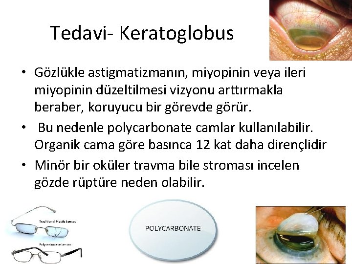 Tedavi- Keratoglobus • Gözlükle astigmatizmanın, miyopinin veya ileri miyopinin düzeltilmesi vizyonu arttırmakla beraber, koruyucu