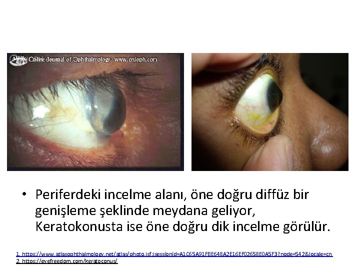  • Periferdeki incelme alanı, öne doğru diffüz bir genişleme şeklinde meydana geliyor, Keratokonusta
