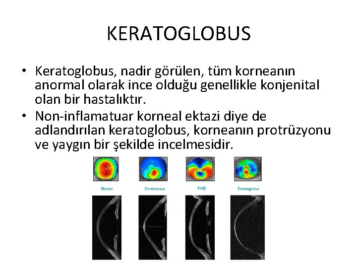 KERATOGLOBUS • Keratoglobus, nadir görülen, tüm korneanın anormal olarak ince olduğu genellikle konjenital olan