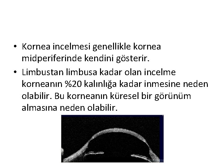  • Kornea incelmesi genellikle kornea midperiferinde kendini gösterir. • Limbustan limbusa kadar olan