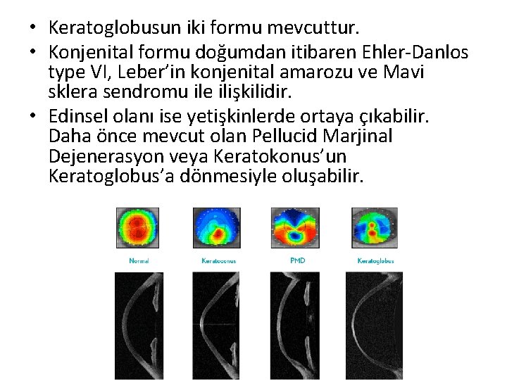  • Keratoglobusun iki formu mevcuttur. • Konjenital formu doğumdan itibaren Ehler-Danlos type VI,