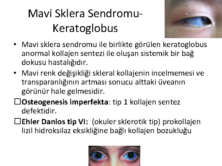 Mavi Sklera Sendromu. Keratoglobus • Mavi sklera sendromu ile birlikte görülen keratoglobus anormal kollajen