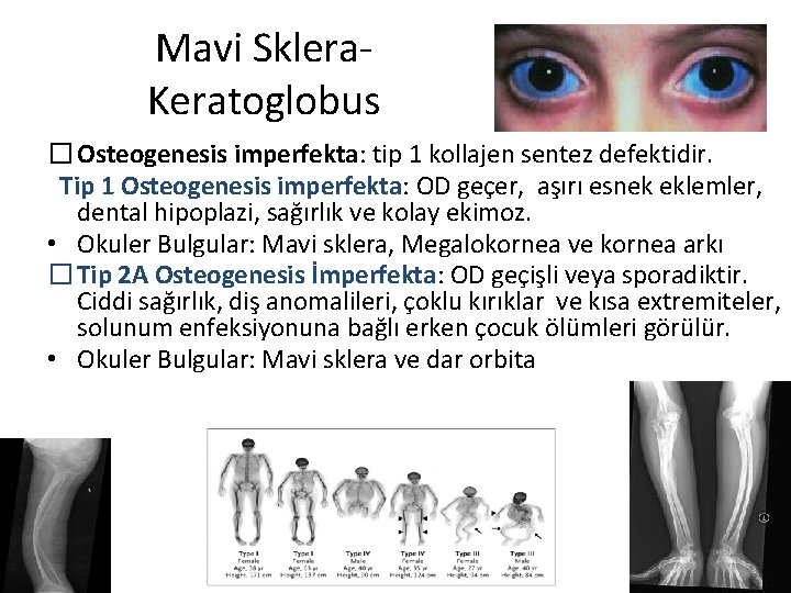 Mavi Sklera. Keratoglobus �Osteogenesis imperfekta: tip 1 kollajen sentez defektidir. Tip 1 Osteogenesis imperfekta:
