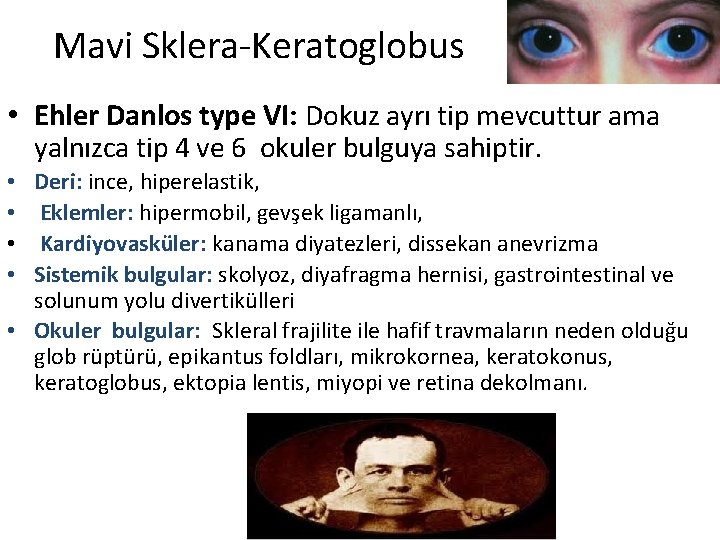 Mavi Sklera-Keratoglobus • Ehler Danlos type VI: Dokuz ayrı tip mevcuttur ama yalnızca tip