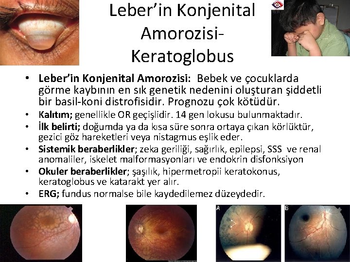 Leber’in Konjenital Amorozisi. Keratoglobus • Leber’in Konjenital Amorozisi: Bebek ve çocuklarda görme kaybının en
