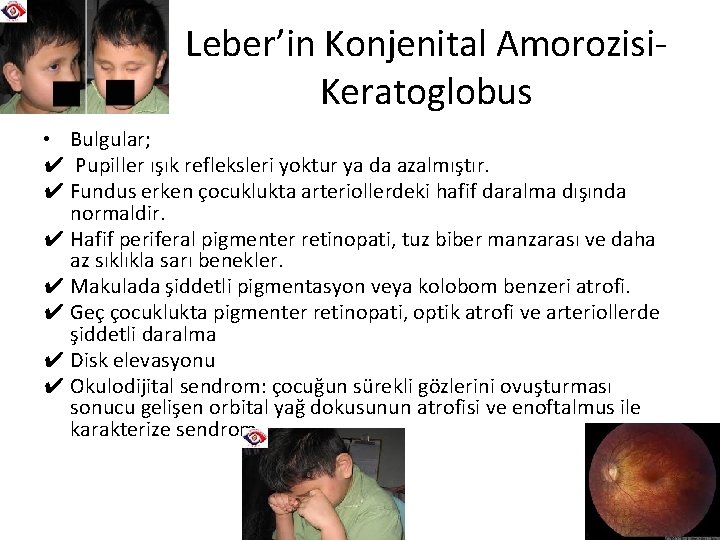 Leber’in Konjenital Amorozisi. Keratoglobus • Bulgular; ✔ Pupiller ışık refleksleri yoktur ya da azalmıştır.