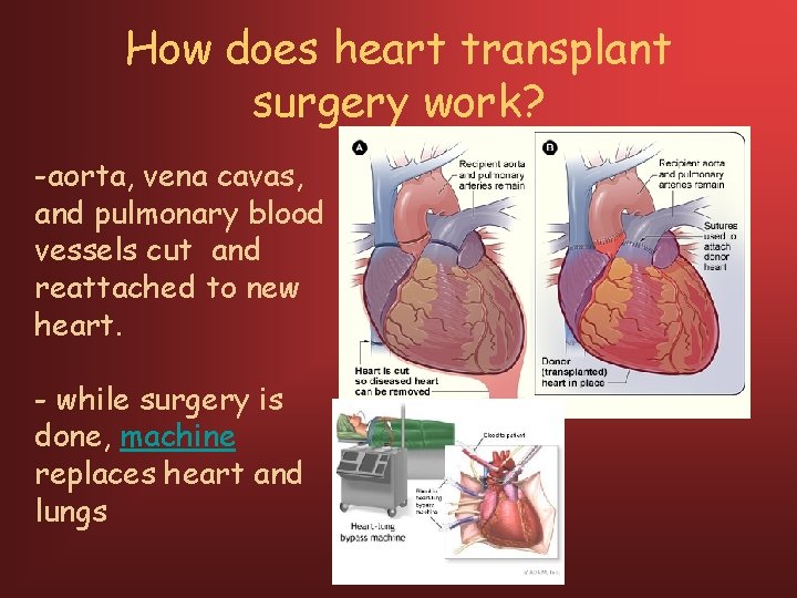How does heart transplant surgery work? -aorta, vena cavas, and pulmonary blood vessels cut