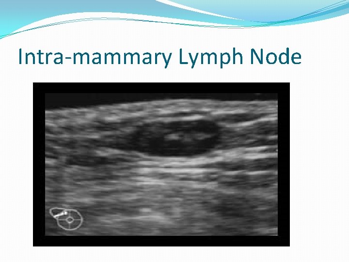 Intra-mammary Lymph Node 