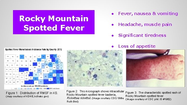 Rocky Mountain Spotted Fever Figure 1: Distribution of RMSF in KS. (map courtesy of