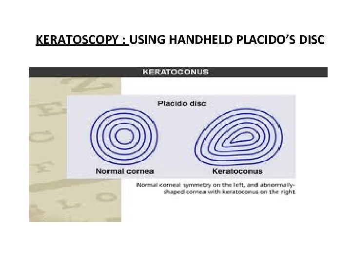 KERATOSCOPY : USING HANDHELD PLACIDO’S DISC 