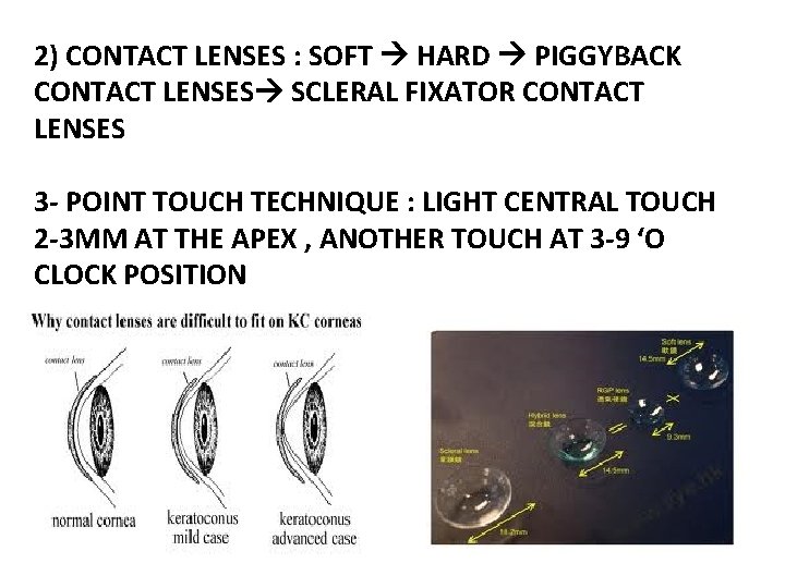 2) CONTACT LENSES : SOFT HARD PIGGYBACK CONTACT LENSES SCLERAL FIXATOR CONTACT LENSES 3