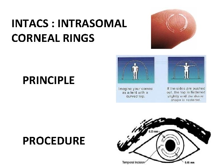 INTACS : INTRASOMAL CORNEAL RINGS PRINCIPLE PROCEDURE 