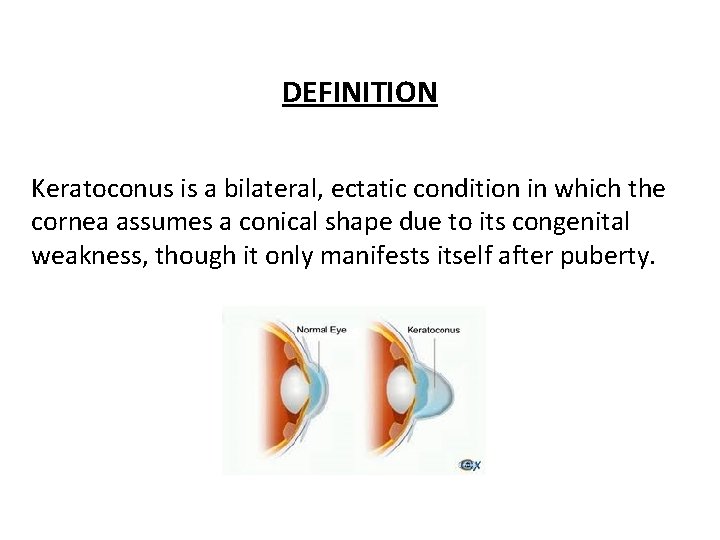 DEFINITION Keratoconus is a bilateral, ectatic condition in which the cornea assumes a conical