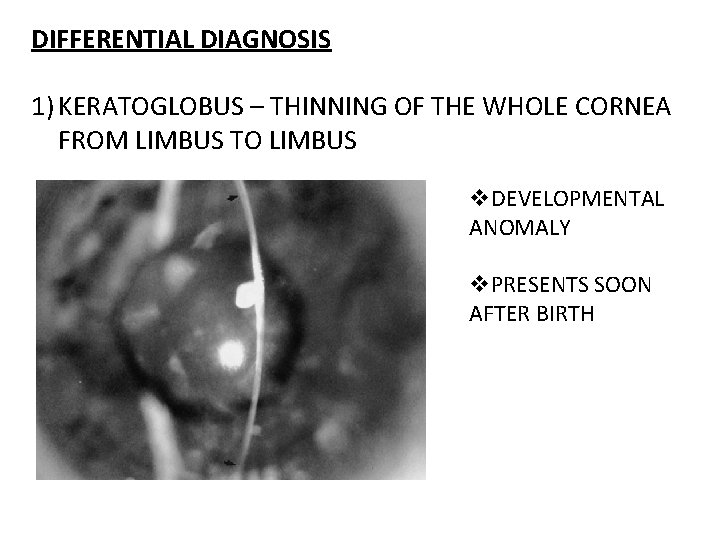 DIFFERENTIAL DIAGNOSIS 1) KERATOGLOBUS – THINNING OF THE WHOLE CORNEA FROM LIMBUS TO LIMBUS