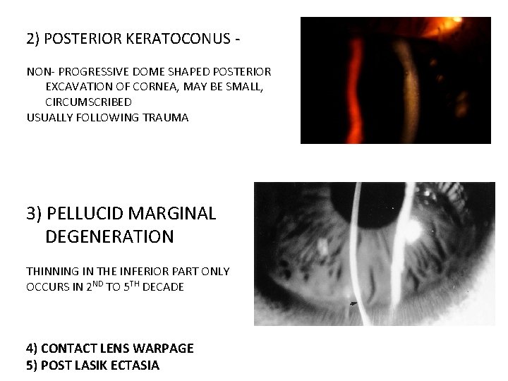 2) POSTERIOR KERATOCONUS NON- PROGRESSIVE DOME SHAPED POSTERIOR EXCAVATION OF CORNEA, MAY BE SMALL,