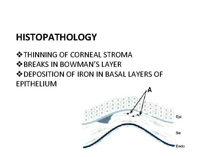 HISTOPATHOLOGY v. THINNING OF CORNEAL STROMA v. BREAKS IN BOWMAN’S LAYER v. DEPOSITION OF