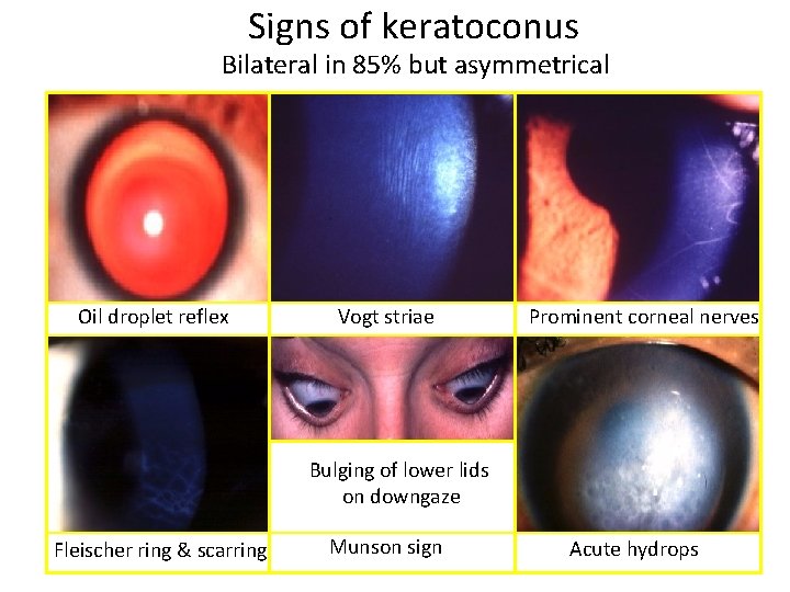 Signs of keratoconus Bilateral in 85% but asymmetrical Oil droplet reflex Vogt striae Prominent