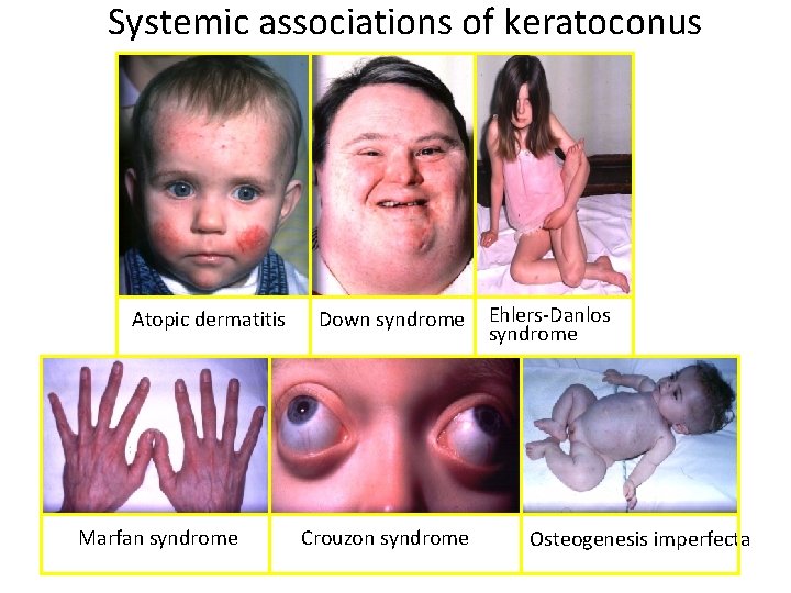 Systemic associations of keratoconus Atopic dermatitis Marfan syndrome Down syndrome Crouzon syndrome Ehlers-Danlos syndrome