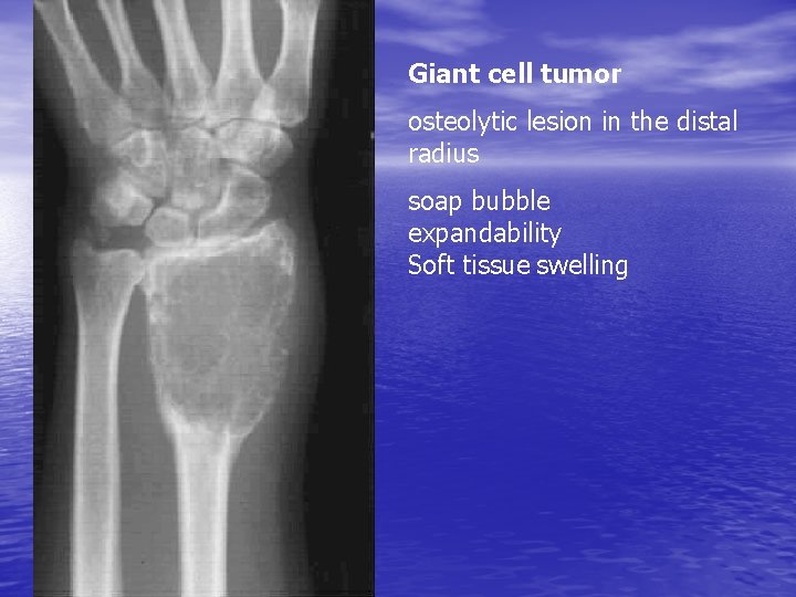 Giant cell tumor osteolytic lesion in the distal radius soap bubble expandability Soft tissue