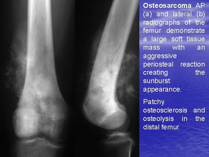 Osteosarcoma AP (a) and lateral (b) radiographs of the femur demonstrate a large soft